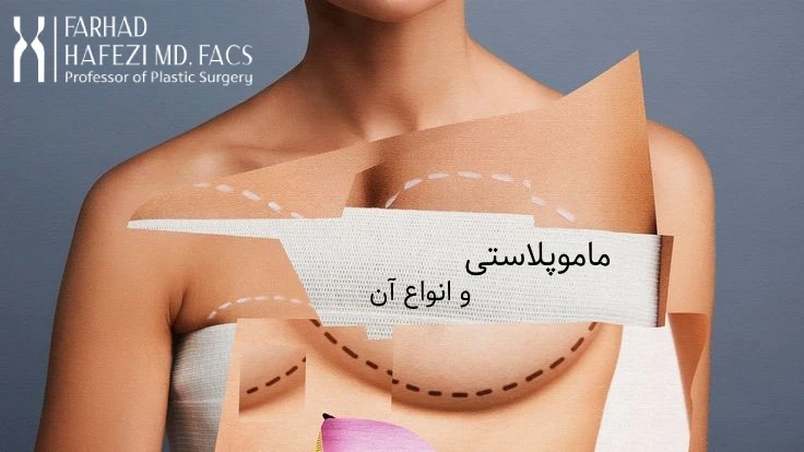 جراحی ماموپلاستی