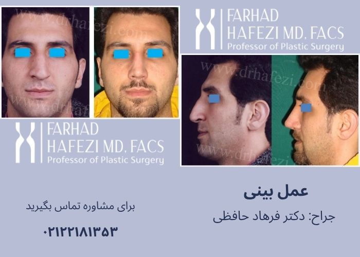 نمونه کار عمل بینی دکتر فرهاد حافظی