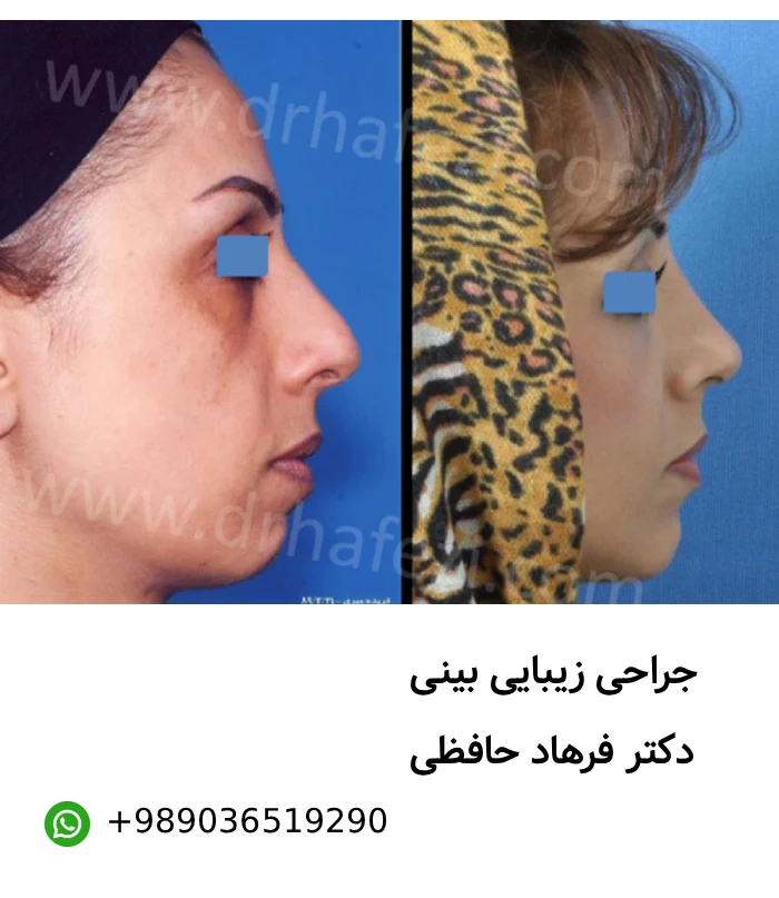 نمونه کار عمل بینی