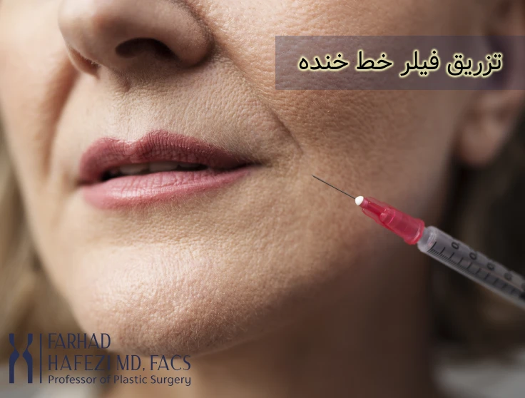 تزریق فیلر صورت در ناحیه خط خنده
