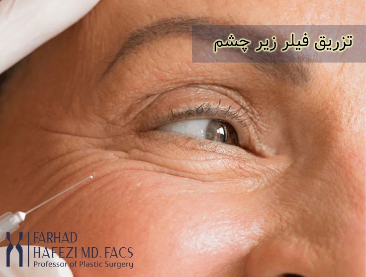 تزریق فیلر صورت در ناحیه زیر چشم