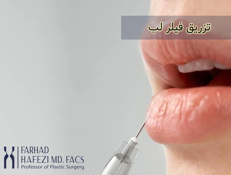 تزریق فیلر صورت در ناحیه لب ها