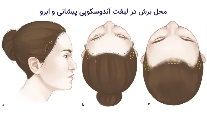 محل برش در لیفت اندوسکوپی ابرو و پیشانی