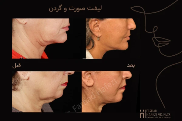 نمونه کار جراحی لیفت صورت و گردن - دکتر فرهاد حافظی