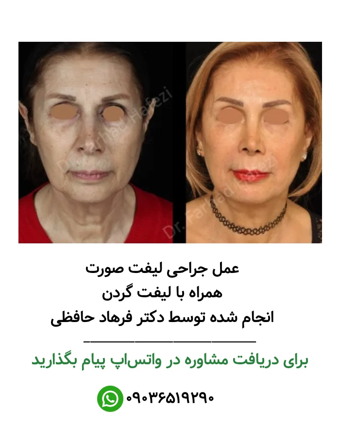 عکس لیفت صورت