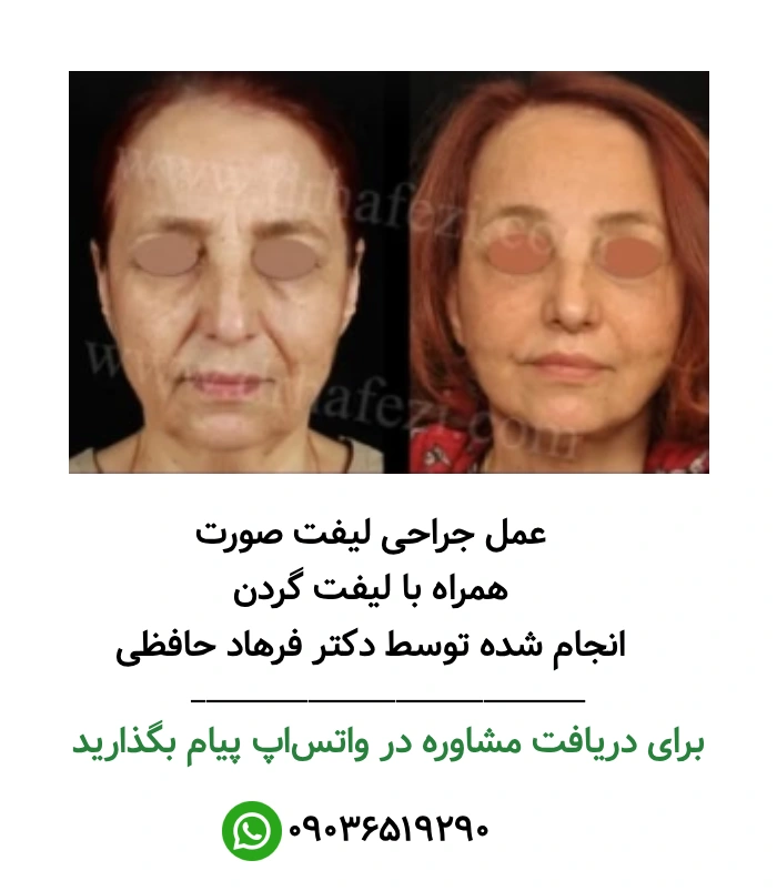 عکس لیفت صورت
