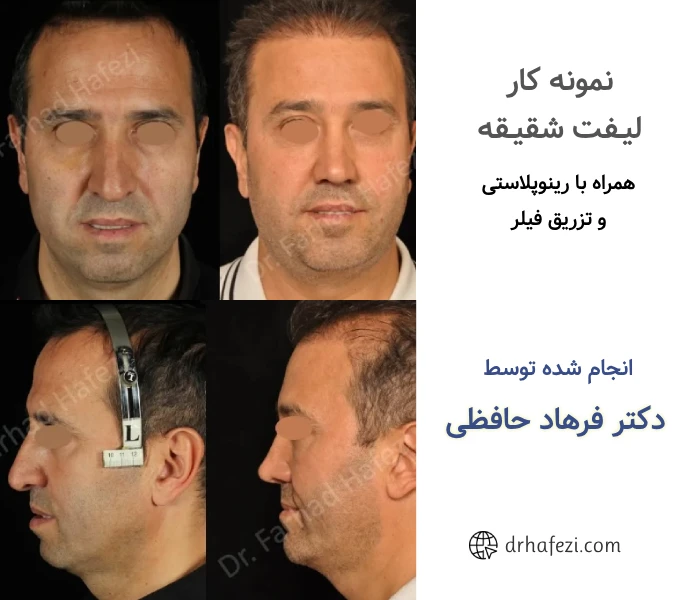 عکس قبل و بعد لیفت شقیقه