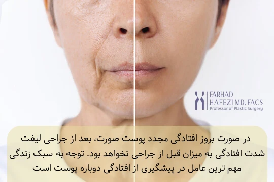 عکس قبل و بعد از لیفت صورت