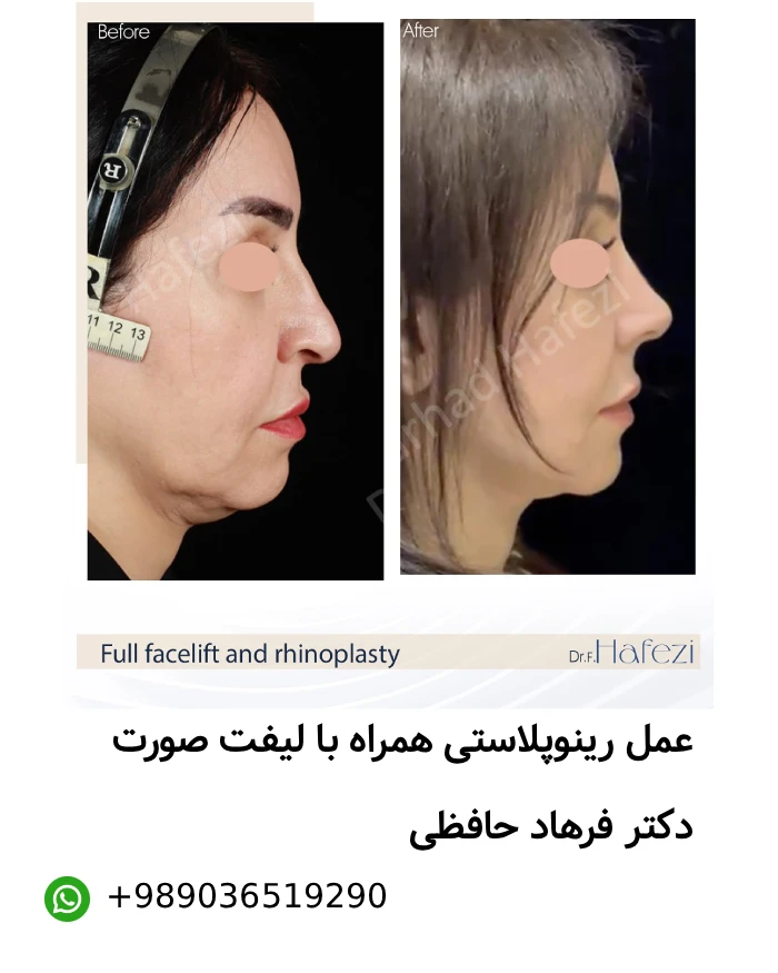 عکس قبل و بعد عمل بینی