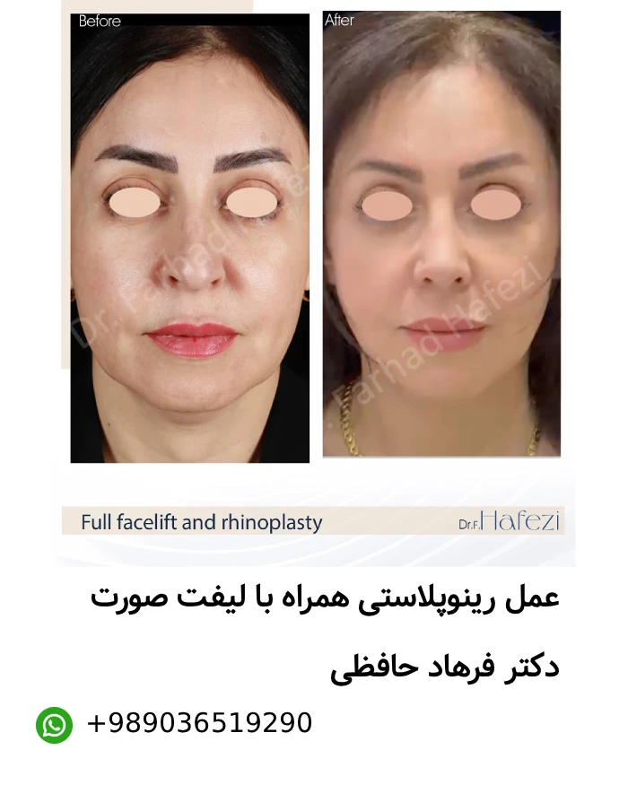 عکس قبل و بعد عمل بینی
