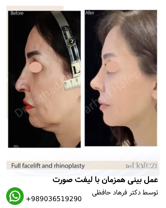 عمل همزمان بینی و لیفت صورت
