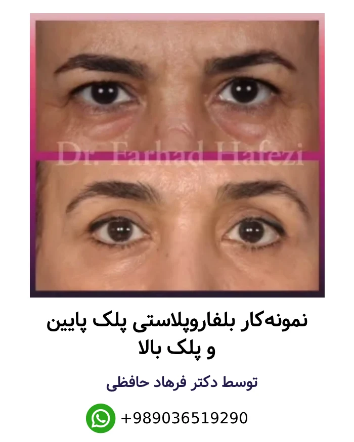 عکس قبل و بعد از بلفاروپلاستی