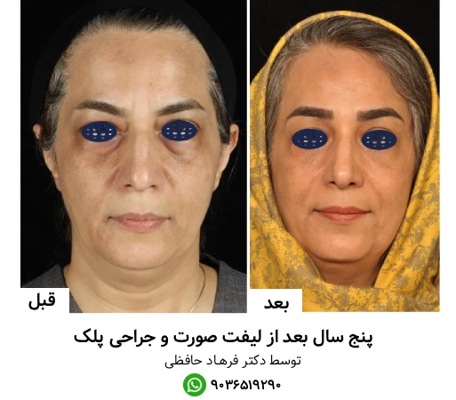 نمونه کار لیفت صورت و جراحی پلک