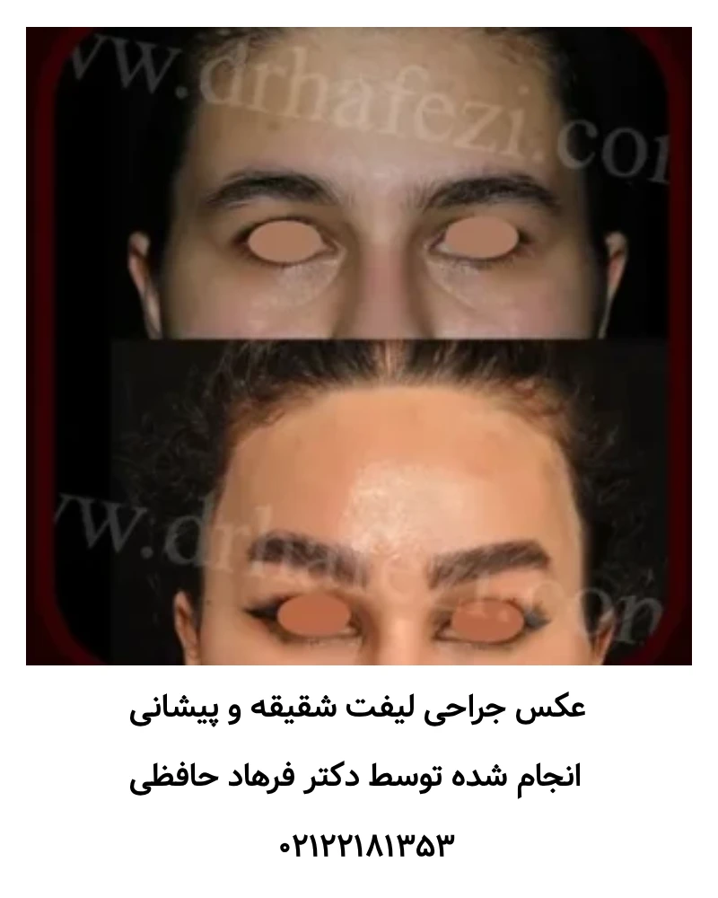 عکس جراحی لیفت ابرو و پیشانی